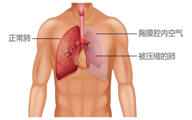 高瘦男性容易得气胸